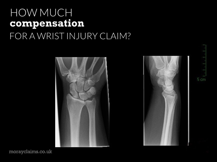 Wrist X-Ray Images