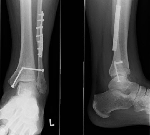 2 x-ray images of a left ankle fracture, with fixing plates and screws in place